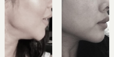 Woman treated with FaceTite - Woman treated with FaceTite and Chin Liposuction