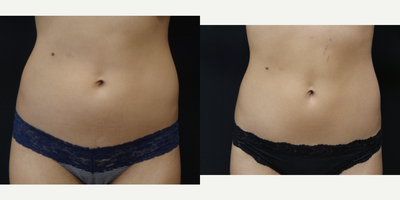 23 year old woman treated with SculpSure to upper and lower abdomen - 23 year old woman after 1 treatment of SculpSure to upper and lower abdomen.  Pictures are 6 weeks after treatment.