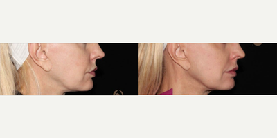 Woman treated with CO2 Laser - CO2RE, Fractional CO2 Resurfacing treatment