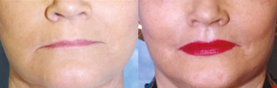 Lip Augmentation - 
	65 year old who underwent permanent surgical lip enhancement.
