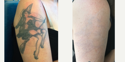 Laser tattoo removal of left arm tattoo - Laser tattoo removal of left arm tattoo