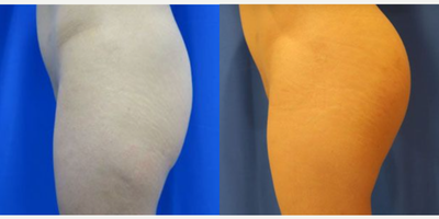 Woman treated with Butt Augmentation - Woman treated with Butt Augmentation using implants