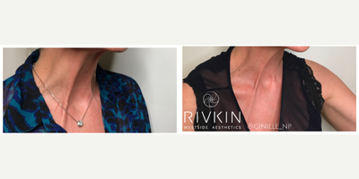 Woman treated with Botox - Neck bands can sometimes form as we age, some patients get treatment here to minimize the appearance! We use Botox to target the muscles that contract to form these bands. The after photo is 1 week once the Botox has kicked in. The muscles are weakened which diminishes the appearance of the bands!