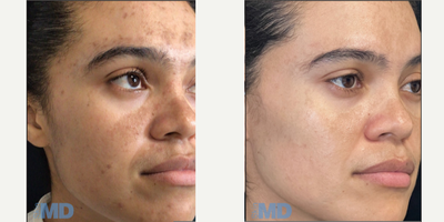 25-34 year old woman treated with Pico Genesis, DiamondGlow - Combo therapies in action! Pico Genesis combined with DiamondGlow Facials to address pigment, melasma and texture.