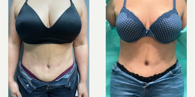 35-44 year old woman treated with Belly Button Surgery - Our wonderful patient received an umbilicoplasty by Dr. Lyly at Vado Plastic Surgery in Winter Garden, Florida! Results are 2 months post-op.