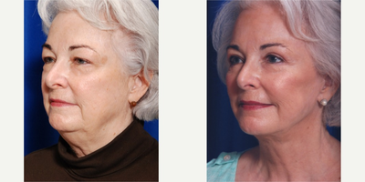 65-74 year old woman treated with Facelift - Facelift and neck lift along with submental liposuction and lipo contouring