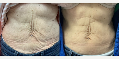 65-74 year old woman treated with Evolve - Our patient with her results from Evolve! Evolve is an innovative hands-free solution that maximizes patient results and provides the highest quality of aesthetic treatments available. This all-in-one platform delivers multiple technologies on one system to remodel skin, target adipose tissue(fat) and tone muscles.