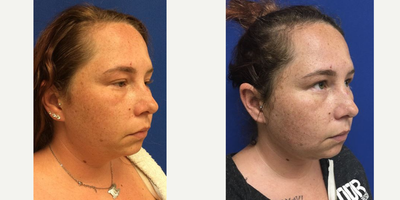 25-34 year old woman treated with FaceTite - Patient treated with FaceTite and Morpheus8