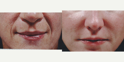 45 year old woman treated with Radiesse - Patient had Radiesse injected to the nasal folds