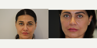 45-54 year old woman treated with Botox, Thread Lift, Silhouette Soft, Xeomin - Face Thread Lift and Xeomin Toxin Eyebrow Lift