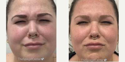 25-34 year old woman treated with Xeomin - botulinum