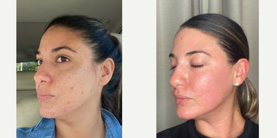FIRST STEPS TOWARDS BETTER SKIN WITH LASER COMBO - My patient wanted to start her journey to soften her acne scars and we did a big treatment as the first step.  At consultation we discussed that this would take many treatments to get her to where she wanted.  She has deep ice pick scars and some active breakouts.  We did not only want to address her scars but took into account the early signs of aging such as the eyelids, neck, and volume lossANTI AGING AND ACNE COMBO  TCA Cross Sculptra  CO2 Laser Plasma Pen TAG A BEST FRIEND WHO MAY WANT THIS TREATMENT 