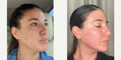 FIRST STEPS TOWARDS BETTER SKIN WITH LASER COMBO - My patient wanted to start her journey to soften her acne scars and we did a big treatment as the first step.  At consultation we discussed that this would take many treatments to get her to where she wanted.  She has deep ice pick scars and some active breakouts.  We did not only want to address her scars but took into account the early signs of aging such as the eyelids, neck, and volume lossANTI AGING AND ACNE COMBO  TCA Cross Sculptra  CO2 Laser Plasma Pen TAG A BEST FRIEND WHO MAY WANT THIS TREATMENT 