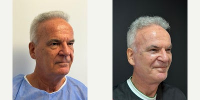 65-74 year old man treated with Facelift - Deep plane face and neck liftBrow liftFat transferUpper and lower BlephoraplastyTemporal lift