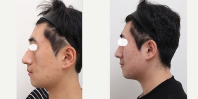 25-34 year old man treated with Nonsurgical Facelift - Chief Complain: Face assymetry, LT cheek dent Treatment Plan: 3 session of facial fat transfer with PRP Outcome: Smooth face line, less visible assymentry, balanced face shape