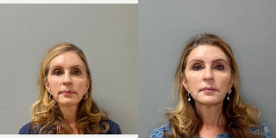 55-64 year old woman treated with Dermal Fillers, Sculptra, Voluma, Radiesse - This woman received Sculptra in her cheeks for a collagen stimulator to enhance a lifting effect. She also received Radiesse in the jaw to help with pre-jowl heaviness. Voluma was injected in the cheekbones for a more prominent look and lifting effect. There were several RHA fillers in the forehead and temple to lift those areas.
