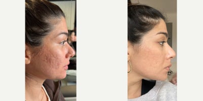 18-24 year old woman treated with Phenol Peel, Halo Laser - When acne scars run deep, the treatment plan has to go deeper.This lovely patient came to me with deep acne scarring on her cheeks, along with some skin laxity and early volume loss  which made the scars appear even more pronounced.We took a customized, multi-layered approach:A modified phenol peel to target the scarring, and a Hybrid Fractional laser to refine texture, tone, and signs of aging across the rest of her face.