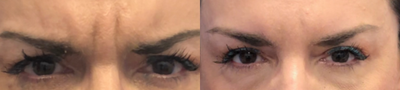 55-64 year old woman treated with Jeuveau - 56 year old female treated with Jeuveau to her forehead, glabella (frown lines) and crows feet wrinkles. Previously treated with Botox.