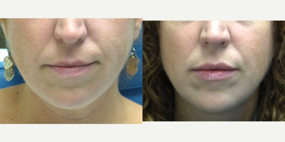 40 year old woman treated with Volbella - This patient was concerned with lip lines and wanted to add some subtle volume.
