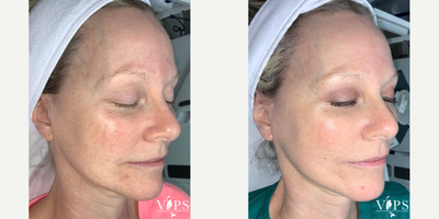 55-64 year old woman treated with CO2 Laser, CoolPeel - 55-64 year old female treated with CO2 laser CoolPeel laser skin resurfacing for skin texture, skin tone, fine lines, wrinkles, and pore size. These results are after one treatment.