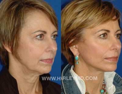55-64 year old woman treated with Facelift - Face and neck lift under local anesthesia performed in the office.