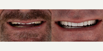 45-54 year old man treated with Smile Makeover, Dental Implants, Dental Bridge, Porcelain Veneers - Completion of this full mouth rehabilitation, we successfully stabilized the patients bite while also enhacing the appearance of the front teeth by adding volume. By opening the bite, we werew able to extend the front teeth, recreating the natural length and appearance the patient previously exhibited at rest.