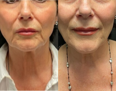 65-74 year old woman treated with NovaThreads - Patient came in for pdo thread lift