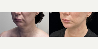 Woman treated with Facelift - Woman treated with Facelift