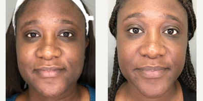35-44 year old woman treated with Vivace - Before and after 2 out of 3 sessions of Vivace face tightening and texture improvement.