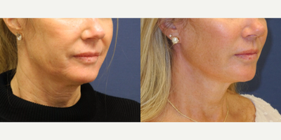 Woman in her mid 50s treated with Facelift as well as Facial Fat Transfer and Liposuction - Woman in her mid 50s treated with Faceliftwith ext pmp andTisseel as well as Facial Fat Transfer, and Liposuction to neckarea, shown 7 months post op.