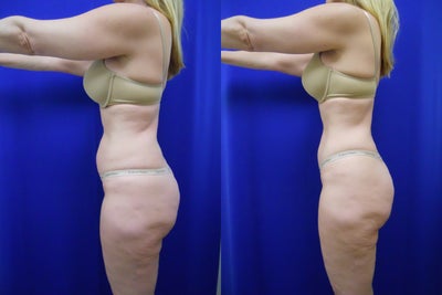 Zerona  - 
	Most of our Zerona patients are interested in moderate, or minimal changes, without surgery or traditional liposuction. This is a perfect example of the type of result that can be achieved with Zerona . The patient underwent a series of treatments, during a period of about 3 three weeks. At the end of the treatment period, the patient has lost a total of 7 pounds. And, she has lost 10 inches overall. The results are obvious; 2 inches lost from her waist, and 2 inches from the hips. She has also lost inches from her arms, thighs.&nbsp;
