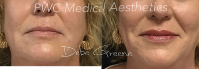 45-54 year old woman treated with Permanent Makeup - Permanent Makeup- Lip enhancement