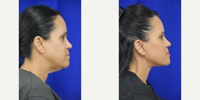 45-54 year old woman treated with Facelift, Lower Facelift - 45-54 year old woman treated with Facelift, Neck Lift, Facial Fat Transfer, Eyelid Surgery