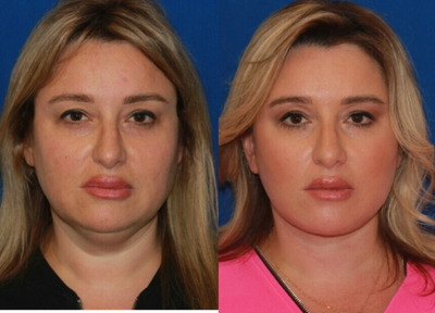 45-54 year old woman treated with Facelift - A Face and Neck lift surgery for the female patient in her 50s helped to achieve beautiful lower face and neck contours, get rid of the skin laxity in the lower face area and fullness under he chin. These excellent rejuvenation boosted patient's confidence and self-esteem!
