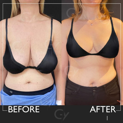 35-44 year old woman treated with Breast Lift - Breast Lift by M.D. Gray Yeiladal