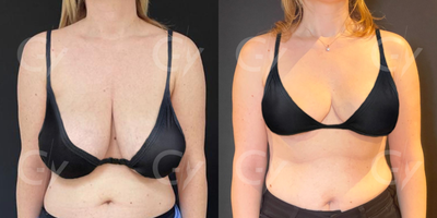 35-44 year old woman treated with Breast Lift - Breast Lift by M.D. Gray Yeiladal