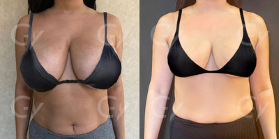 35-44 year old woman treated with Breast Reduction - Breast Reduction by M.D. Gray Yeiladal