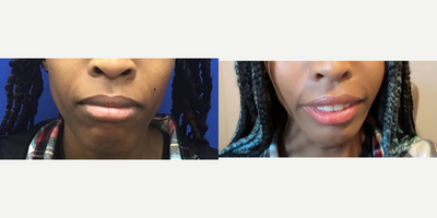 Patient treated with Genioplasty - Chin Implant (Central) with Chin Reduction and Contour - 25 to 34 year-old female patient is 5 months post-op from Facial Feminization surgery. Her procedures included: Forehead Lift, Hairline Lowering, Orbital Bony Contouring; Chin Implant (Central) with Chin Reduction and Contour; Cheek Implants (Small); Thyroid Cartilage Shave and Voice Feminization; Fascia to Upper Lip; Internal Lip Lift and Septorhinoplasty (Closed) with Cartilage Grafts.