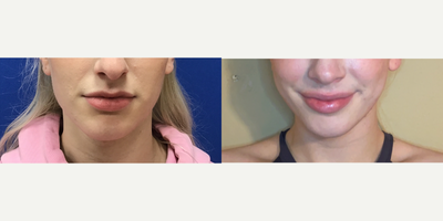 Patient treated with Genioplasty - Chin Reduction and Contour - 18 to 24 year-old female patient is 6 months post-op from Facial Feminization surgery. Her procedures included: Forehead Lift, Hairline Lowering, Orbital Bony Contouring; Septorhinoplasty (Closed) with Cartilage Grafts, Radix Graft and Weirs; Cheek Implants (Small); Chin Reduction and Contour; Subnasal Lip Lift with Fat Augmentation to Lips; Thyroid Cartilage Shave and 300 Micrografts to Recessions.