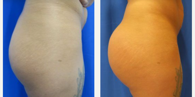 Woman treated with Butt Augmentation - Woman treated with Butt Augmentation using implants