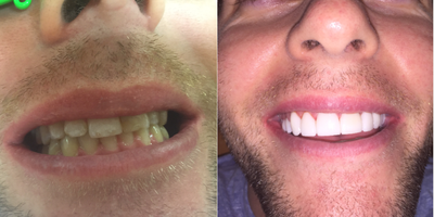 30 year old man treated with 10 Porcelain Veneers - Patient had some discoloration of his teeth and a previous chipped tooth that had been repaired with bonding by his previous dentist. He was looking for Lumineers or Porcelain veneers to beautify his smile. Dr. Thompson offered him both options, and he ended up deciding on porcelain veneers because he didn't want to worry about them falling off or not being durable enough. His veneers took only 2 appointments from start to finish and he now has permanently white straight teeth.