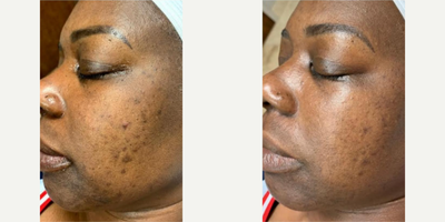 Woman treated with Chemical Peel - Woman treated with Chemical Peel using NeoStrata Retinol Peels with two treatments done 3 weeks apart