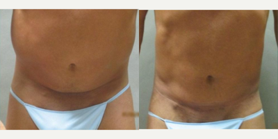 Man treated with Male Tummy Tuck - Man treated with Male Tummy Tuck