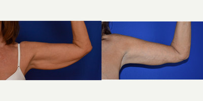 35-44 year old woman treated with Arm Lift - Arm lift
