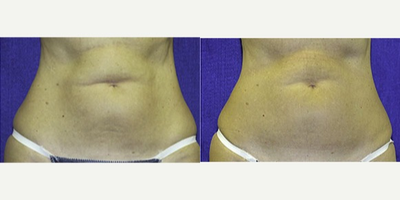 45-54 year old woman treated with Liposonix - 45-54 year old woman treated with Liposonix