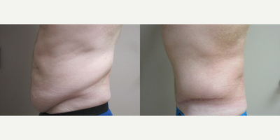 Male Tummy Tuck - Male patient that has lost approximately 140 pounds requested Abdominoplasty to tighten muscles and removal of excessive skin.