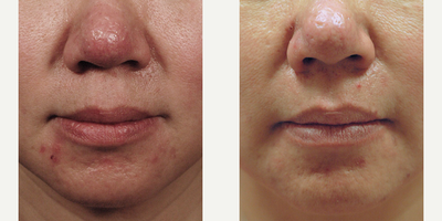 Pulsed Dye Laser Treatment for Rosacea - Before and after pulsed dye laser treatment (with bruising) for Rosacea.