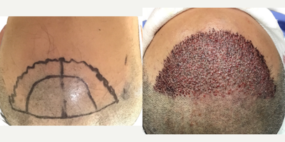 39 year old man treated with FUE Hair Transplant, Minoxidil and Low-Level Laser Therapy (BIOLIGHT Laser Cap) - This is a 39-year-old male who came to us with a history of hair loss spanning more than 10 years, starting in his late 20s. At the time of his consultation, he was not on any medications or taking any steps to slow or stop his hair loss. There was a strong family history of hair loss in his father and maternal grandfather. What bothered him most was the thinning in the frontal scalp as well as the appearance of a very deep widows peak on both sides of the hairline. You can see in the frontal view that, with the extent of thinning, you can see almost as far back as the mid-scalp. He was seeking a more youthful hairline with added density in the frontal scalp. This was his first surgery. He had a 1500 graft FUE to rebuild the hairline and add density behind it in the frontal scalp. Being close to 40 years old he wanted the resulting shape and density to appear as natural as possible. We used an irregularly irregular scalloped design to mimic the natural appearance of a hairline, focussing on density in the nearly empty areas just behind the hairline. Additional density was placed behind that. At the same time, he was started on a preventive regimen of high-strength minoxidil and the BIOLIGHT laser cap to prevent any more ongoing hair loss. He returned to us 11 months after his surgery with amazing results and hes very happy! The widows peak has been softened and weve been able to maintain natural, masculine corners in the fronto-temporal angles (where the front hairline meets the side hairline). There is enough density in the frontal scalp that you cant see through it to the mid-scalp behind anymore. The donor area looks amazing and you cant tell that any grafts have been extracted from that area. In fact, nobody who just met him would be able to tell that hes had any hair transplant surgery at all! The supplementary therapies (minoxidil and laser cap) have worked really well so far to help him keep the hair he still has, and theres been no progression of his hair loss in other areas. We discussed a long-term maintenance strategy and hes going to continue with his high-strength minoxidil and BIOLIHT laser cap indefinitely. If he ever decides to seek just a little added density in the crown, we discussed the possibility of starting platelet-rich plasma (PRP).