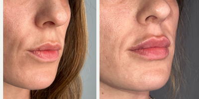 25-34 year old woman treated with Juvederm, Lip Fillers - Patient treated with one syringe of Juvederm Ultra XC