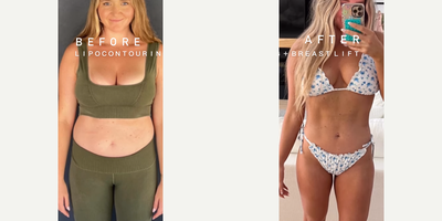 Woman treated with Liposuction - Woman treated with Liposuction and anchor Breast Lift without implants as part of her Mommy Makeover, shown 4 months post op.